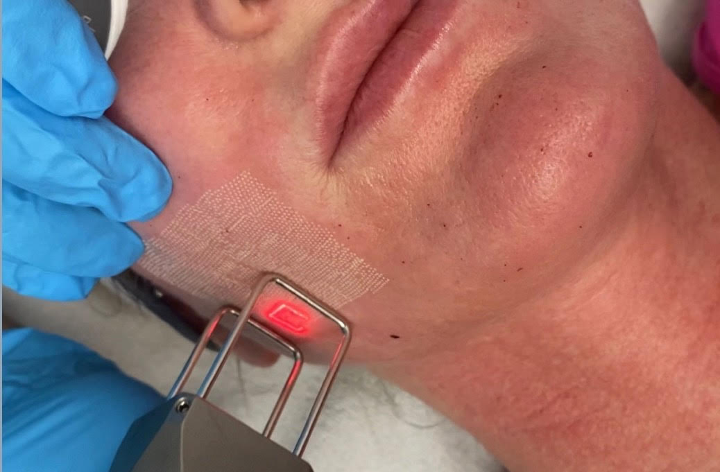 human-medica-LASER CO2-FRAZIONATO human-medica-LASER CO2-FRAZIONATO